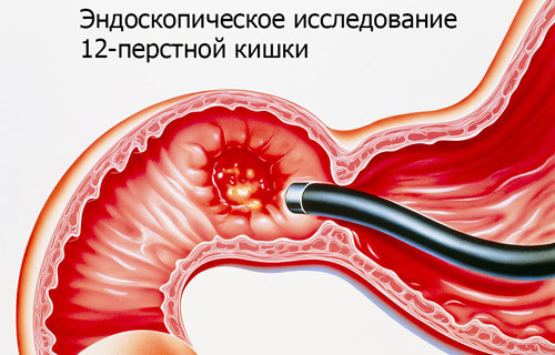 Эндоскопическое исследование пищевода, желудка и 12-перстной кишки 