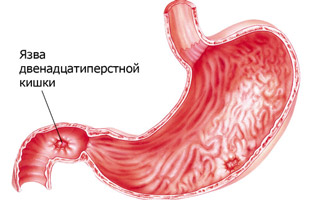 Язва двенадцатиперстной кишки и желудка