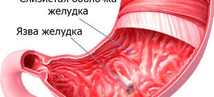 повреждение слизистой желудка и язва