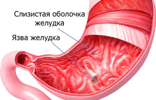 повреждение слизистой желудка и язва 