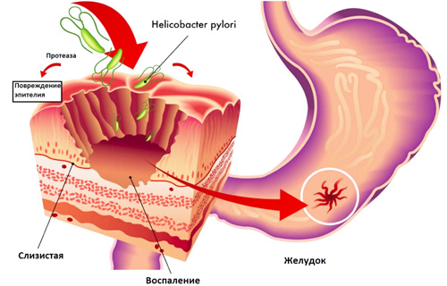 язва желудка и Хеликобактер пилори