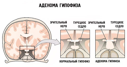 влияние аденомы на зрительный нерв