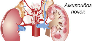 поражение почек амилоидоза