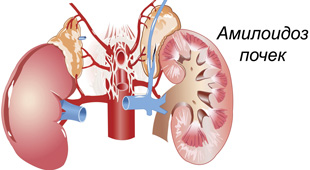 поражение почек амилоидоза