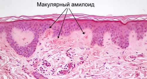 первичный амилоидоз кожи под микроскопом