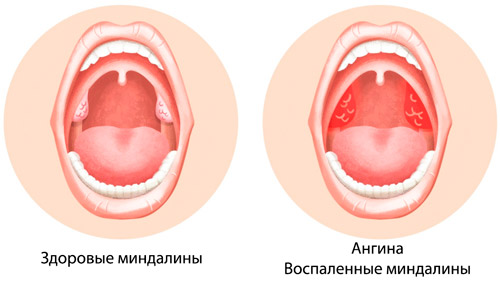 здоровые миндалины и воспаленные при ангине