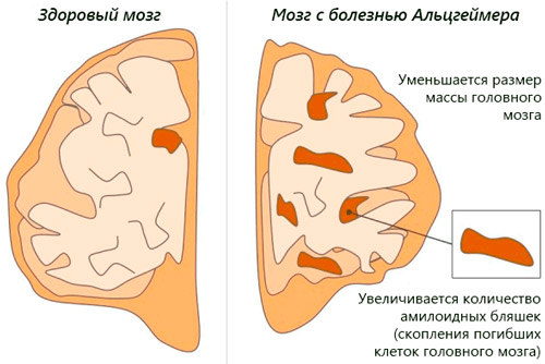 изменения здорового мозга при болезни мозг здорового человека и с болезнью Альцгеймера