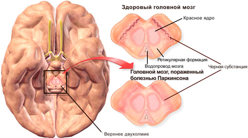 здоровый мозг и пораженный болезнью Паркинсона