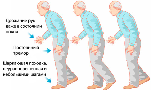 дрожательная форма болезни Паркинсона