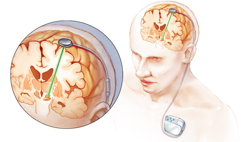 глубокая стимуляция мозга при лечении болезни Паркинсона