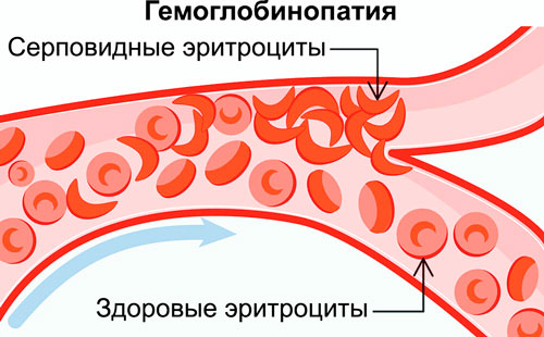 гемоглобинопатия: здоровые и серповидные эритроциты