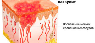 воспаление кровеносных сосудов при геморрагическом васкулите