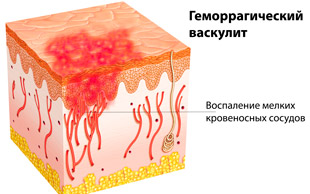 воспаление кровеносных сосудов при геморрагическом васкулите