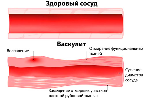 здоровый сосуд и воспаленный при васкулите