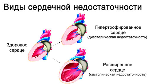 разновидности сердечной недостаточности