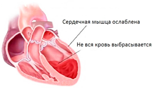 признаки хронической сердечной недостаточности