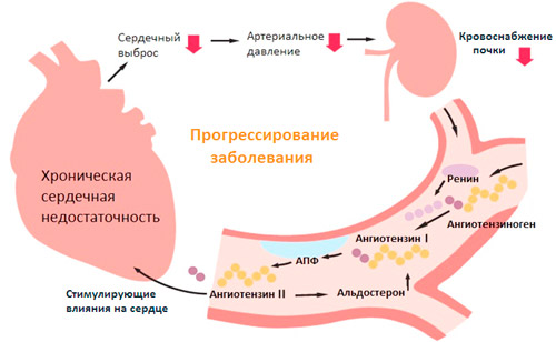 схема прогрессирования хронической сердечной недостаточности