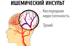 ишемический инсульт головного мозга