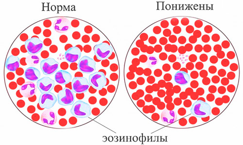 нормальное содержание эозинофилов(лейкоцитов) и лейкопения