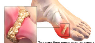 подагра сустава большого пальца стопы