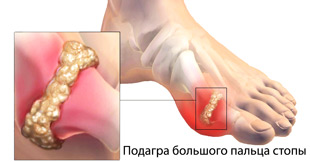 подагра большого пальца стопы