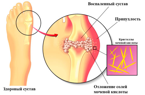 отложения мочевой кислоты в суставах