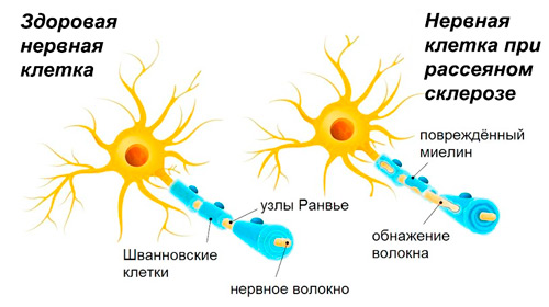 здоровый нерв и нерв при рассеянном склерозе