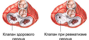 клапан здорового сердца и при ревматизме