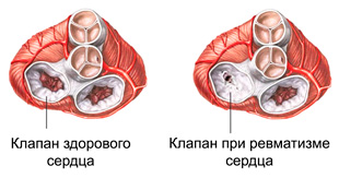 клапан здорового сердца и при ревматизме