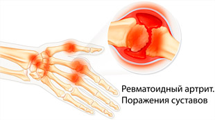 Ревматоидный артрит. Поражения суставов