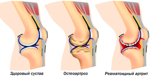 здоровый коленный сустав, пораженный остеоартрозом и артритом