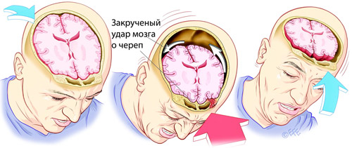 удар мозга о череп при травме готовы