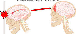 сотрясение головного мозга при удвре