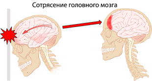 сотрясение головного мозга при ударе