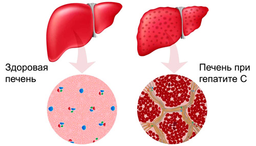 здоровая печень и при гепатите 