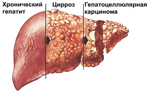 развитие заболевания печени при хроническом гепатите