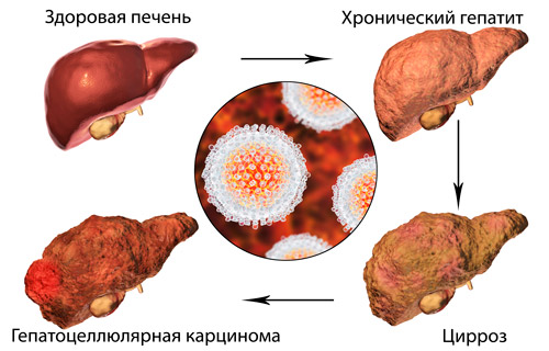 стадии поражения печени при вирусном гепатите