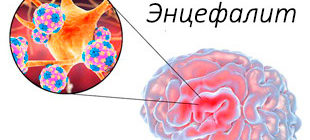 воспаление мозга при энцефалите