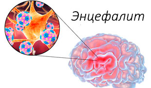 воспаление мозга при энцефалите