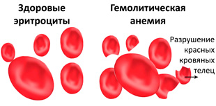 здоровые эритроциты и при гемолитической анемии