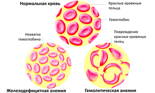 изменение кровяных телец при различных видах анемии