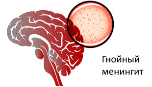 гнойный менингит мозга от проникновения бактерий