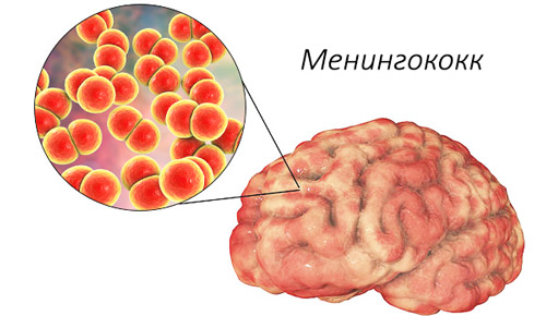 менингококковая инфекция в мозге