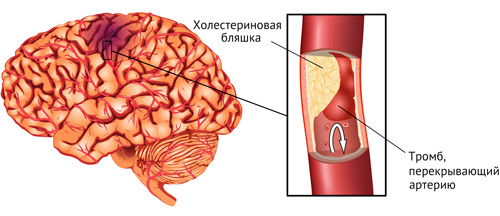 тромб как причина инсульта