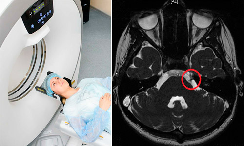 мрт исследование тройничного нерва