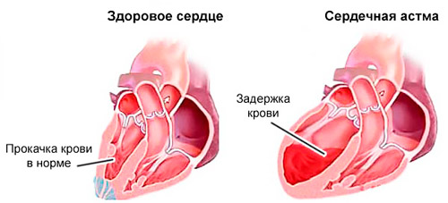 здоровое сердце и при сердечной астме