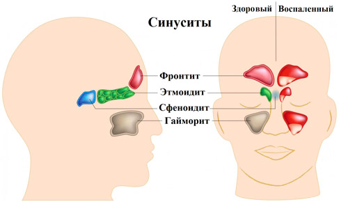 разновидности синуситов в зависимости от локализации