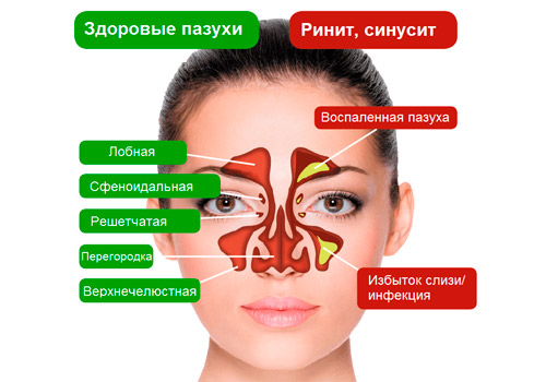 здоровые носовые пазухи и при синусите