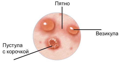 стадии изменения сыпи при ветрянке