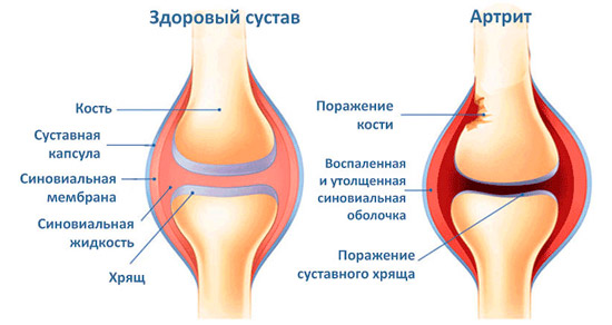 здоровый сустав и пораженный артритом